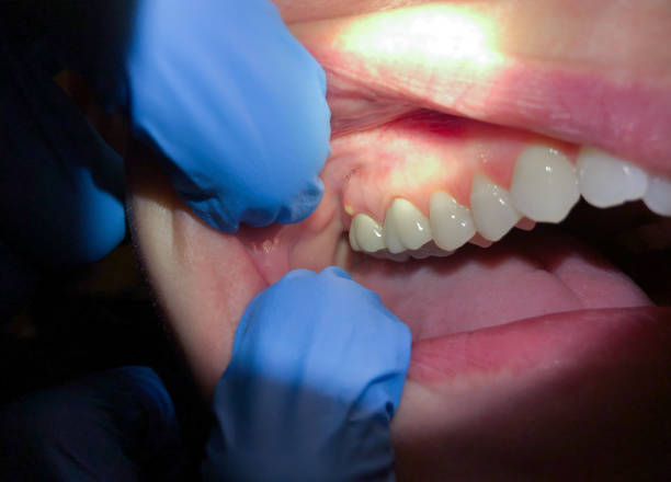 Best Emergency Treatment for Oral Infections in Pu, HI